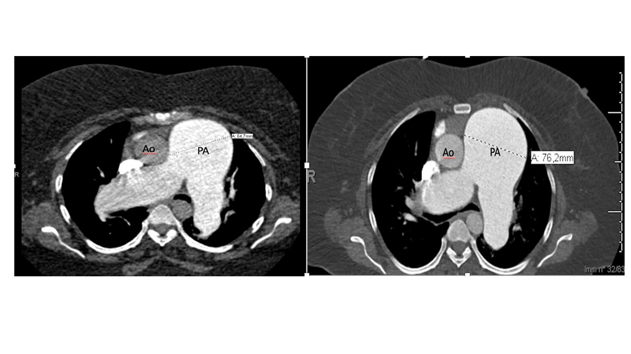 Compressione ab estrinseco del tronco comune da rapida dilatazione dell’arteria polmonare in paziente con ipertensione polmonare.