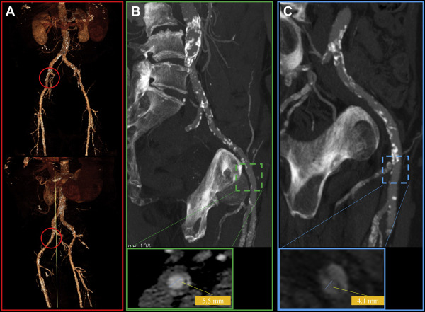 Rottura di arteria femorale in paziente sottoposto a litotrissia intravascolare durante TAVI: approccio ad un caso complesso e gestione delle complicanze