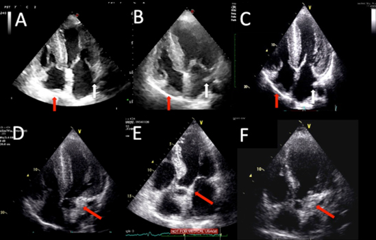 Prevalenza e valore diagnostico di siti di deposito extra-ventricolari all’ecocardiogramma, in strutture non convenzionali nell’amiloidosi cardiaca da transtiretina.