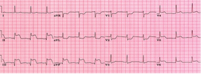 Trombosi endoluminale di aneurisma coronarico misconosciuto come causa di infarto miocardico acuto. Strategia medica, percutanea, chirurgica o combinata?