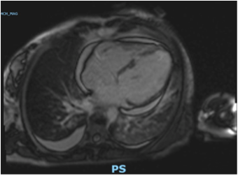 Cardiomiopatia dilatativa e trombosi intraventricolare sinistra come manifestazioni cliniche di granulomatosi eosinofila con poliangioite: un case report.