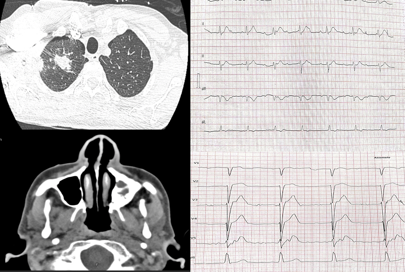 Complete heart block as a rare manifestation of granulomatosis with polyangitis: a case report