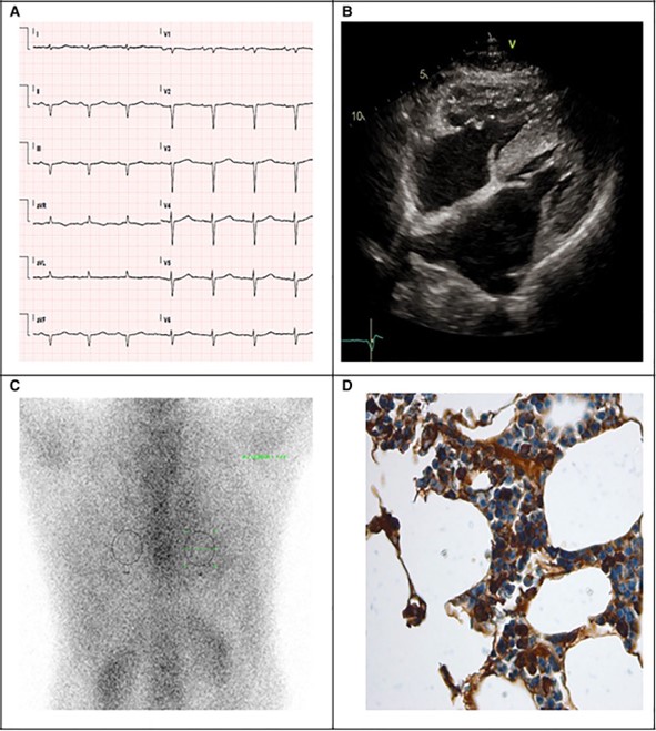 Light-chain cardiac amyloidosis: a case report of extraordinary sustained pathological response to cyclophosphamide, bortezomib, and dexamethasone combined therapy