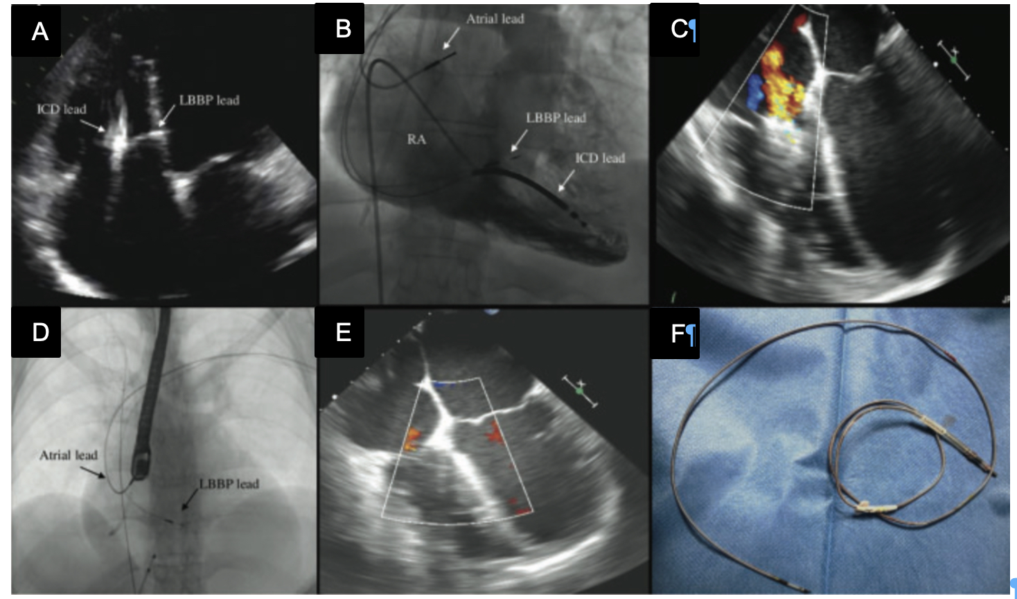 Transvenous extraction of left bundle branch pacing lead: a safe procedure?