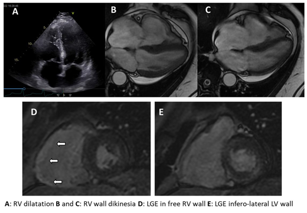 Un caso inaspettato di cardiomiopatia aritmogena del ventricolo destro (ARVC).