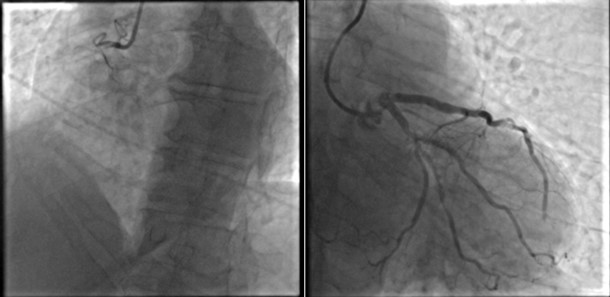 Due culprit per uno STEMI?