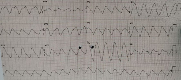 Arresto Cardiaco da intossicazione da Flecainide