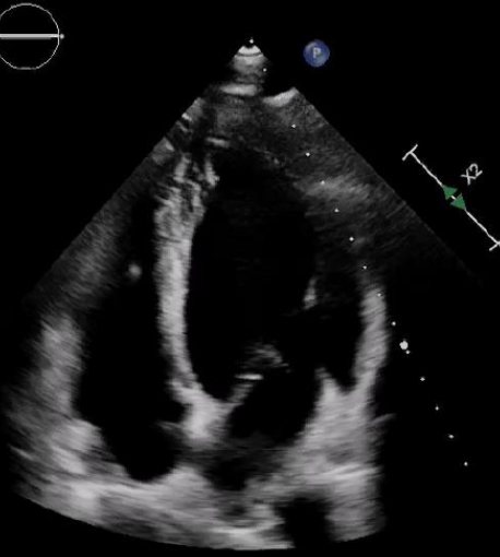 Miocardite acuta in giovane paziente con malattia infiammatoria cronica intestinale
