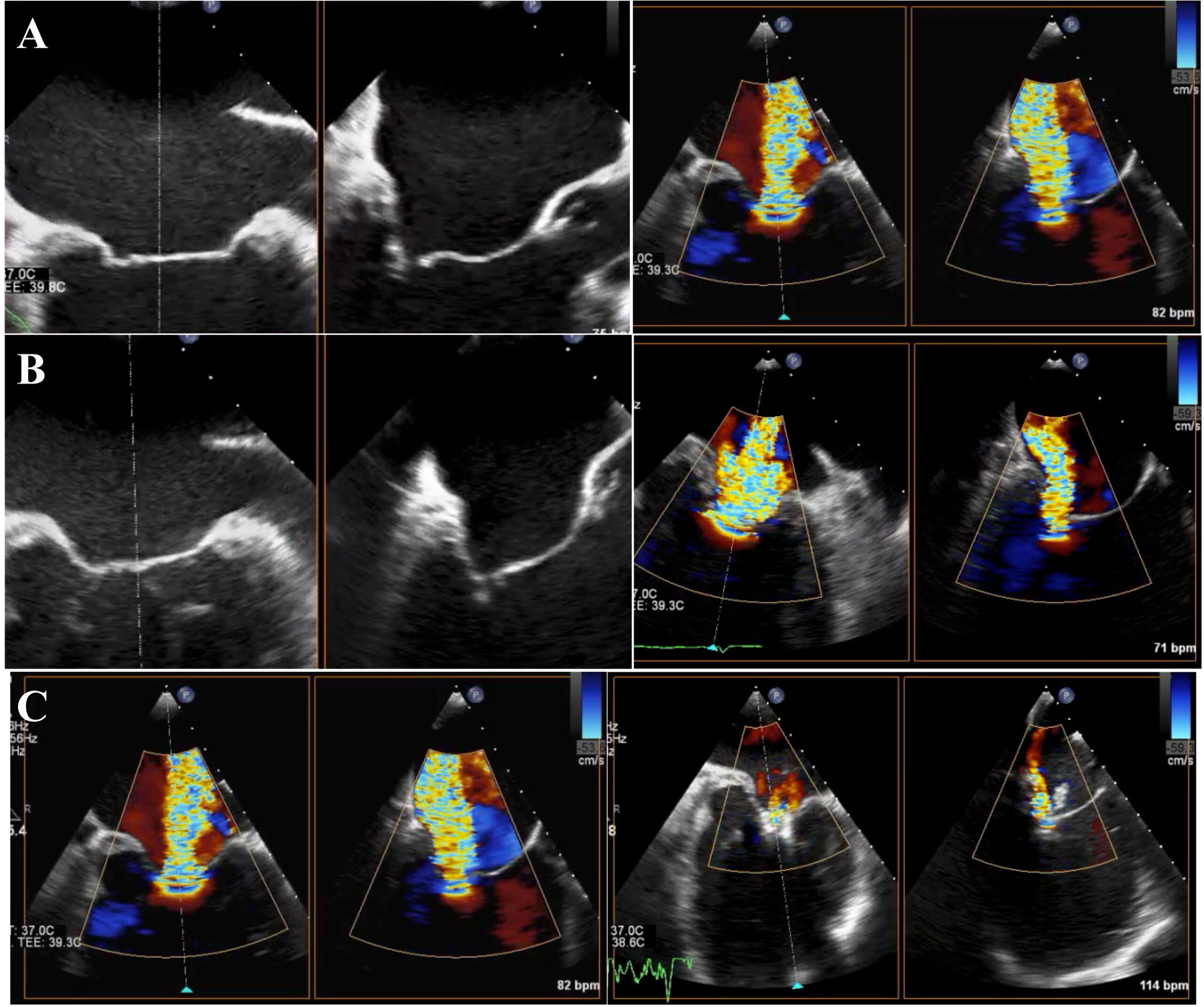 MitraClip procedure as a bridge therapy to heart transplantation after a combined pharmaco-mechanical treatment