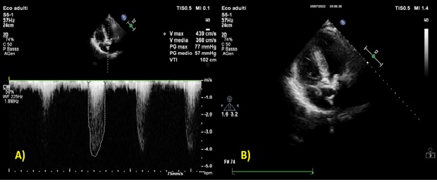 TAVI in paziente affetto da sindrome di Niemann – Pick e situs inversus totalis