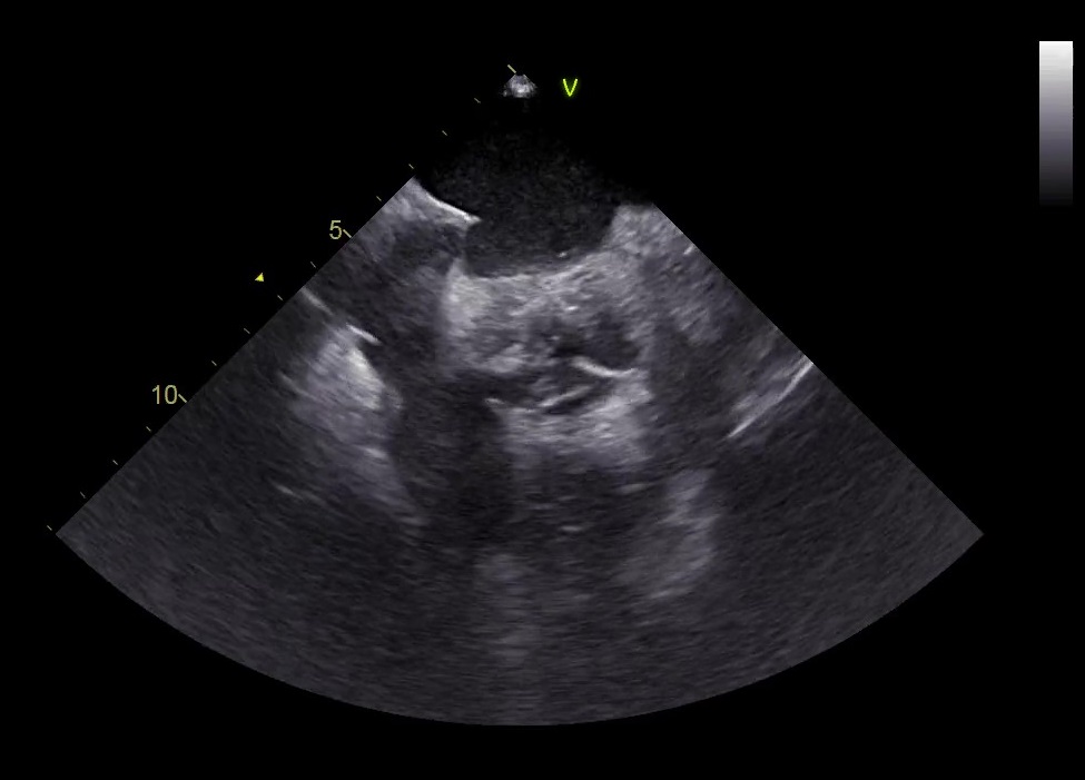 Procedura combinata di chiusura dell’auricola sinistra e crioablazione di fibrillazione atriale guidata da minimalistic approach imaging