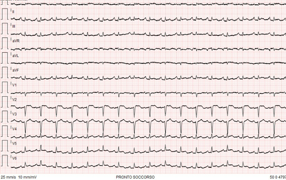 Shock cardiogeno come prima manifestazione di cardiotossicità indotta da antracicline