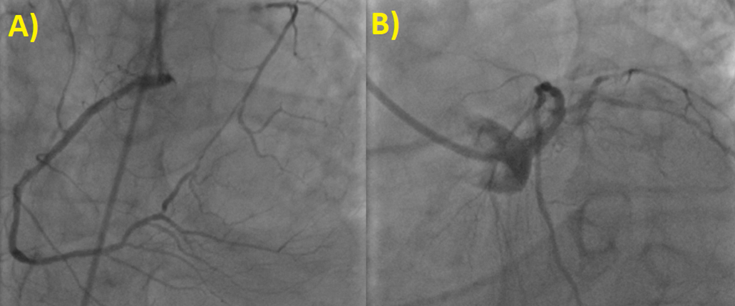 Staged protected percutaneous coronary intervention with Impella CP® device in patient with recent acute coronary syndrome, arrhythmic storm, and severe left ventricular dysfunction: sometimes waiting is better!