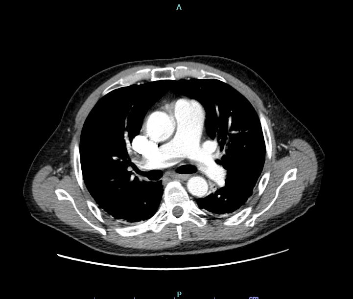 Embolia polmonare ad alto rischio: quando la terapia interventistica è la meno rischiosa