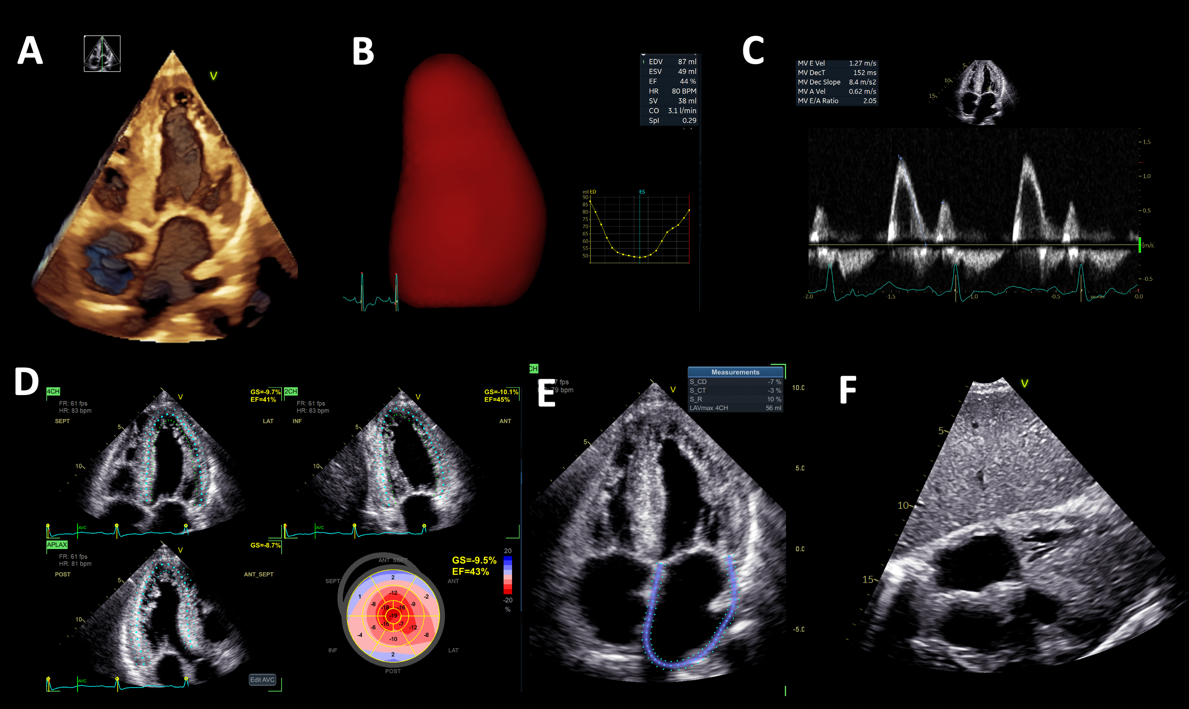 Riscontro occasionale di trombo in auricola atriale destra in un giovane paziente con scompenso cardiaco congestizio e in ritmo sinusale