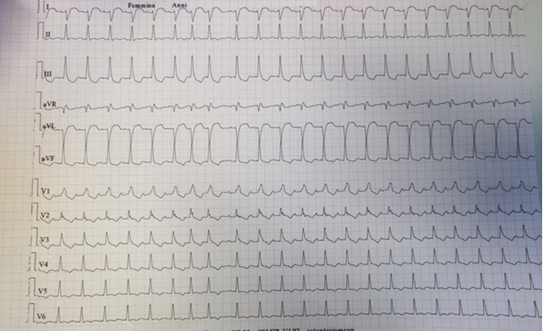 Cardiotossicità da immune checkpoint inhibitors: non solo miocardite.