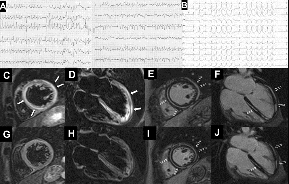 Un raro caso di cardiomiopatia non-amiloidotica da depositi di catene leggere con pattern aritmogeno alla risonanza magnetica