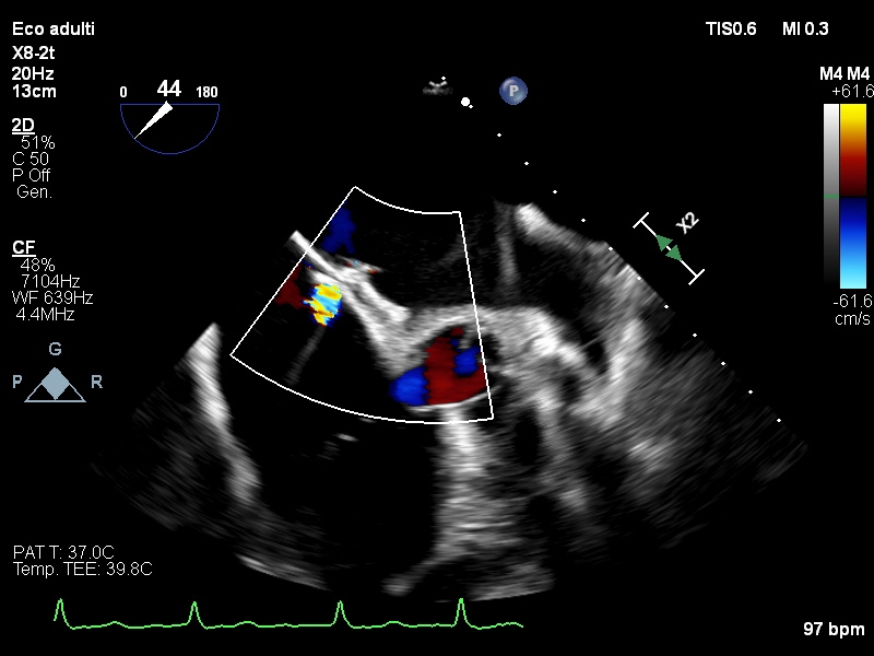 “Two is better than one”: chiusura percutanea dell’auricola sinistra in paziente portatore di dispositivo occlusore di difetto interatriale.