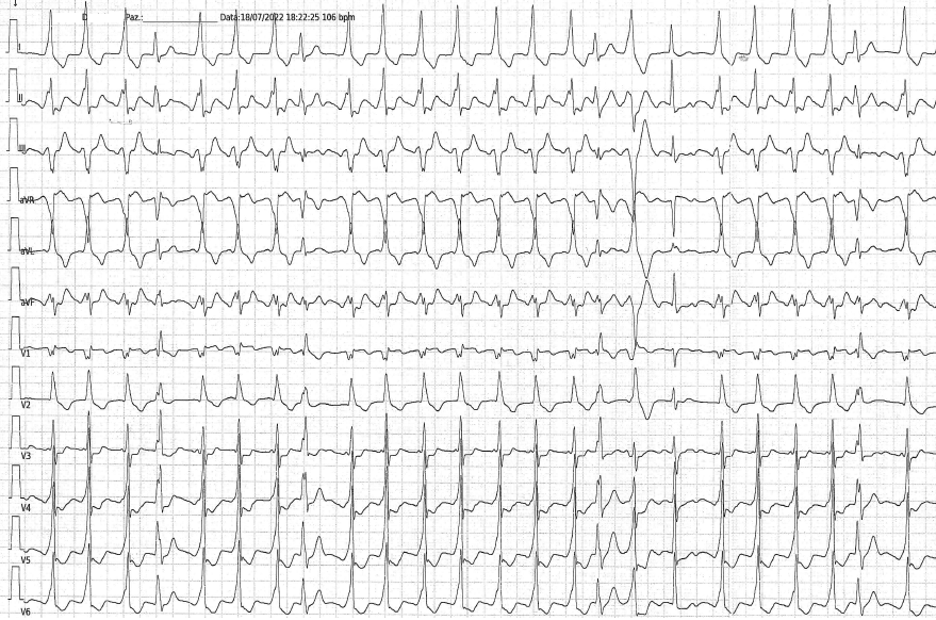 Ventricular ectopy unmasked: ectopia ventricolare maligna da sistema del Purkinje in paziente con Wolff-Parkinson-White