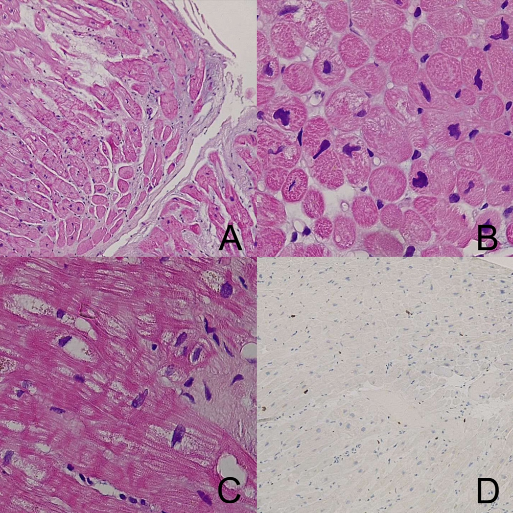 Cardiomiopatia infiammatoria cronica: dalla presentazione clinica all’interpretazione della risonanza magnetica e della biopsia cardiaca