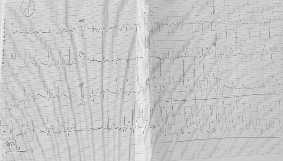 Tachicardia ventricolare da RVOT: il mappaggio elettroanatomico tridimensionale come chiave per la diagnosi differenziale tra forma idiopatica e cardiomiopatia aritmogena del ventricolo destro.