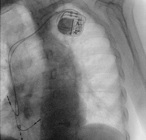 Peak strain dispersion nel pacing della branca sinistra: case report