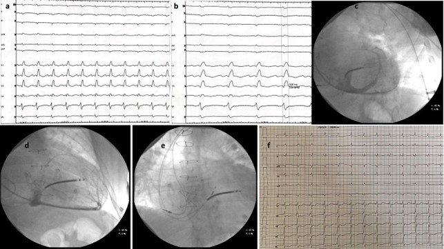 Pacing del Sistema di Conduzione per re sincronizzare il cuore trapiantato: un case-report