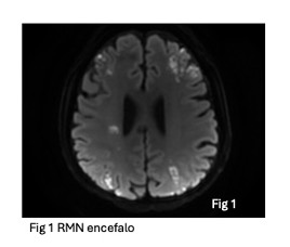 UN CASO DI MINOR STROKE COME ESORDIO DI UNA MIOCARDITE EOSINOFILA SUBACUTA